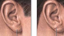 La presencia de un pliegue diagonal en el lóbulo de la oreja podría avisar del riesgo de ictus o infarto