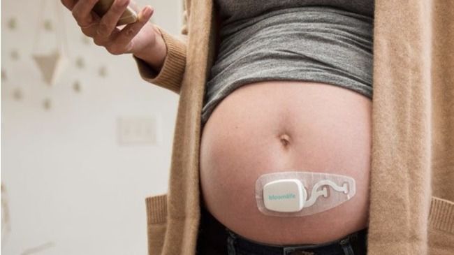 Un dispositivo de Bloomlife permite controlar las contracciones falsas del embarazo previas al parto