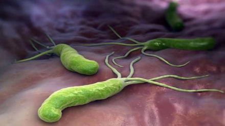 Helicobacter pylori, antecedentes familiares y dieta, principales causas del cáncer de estómago