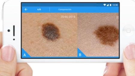 Aplicaciones para detectar el cáncer de piel
