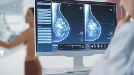 Prueban un algoritmo que permitiría predecir riesgo de cáncer de mamas