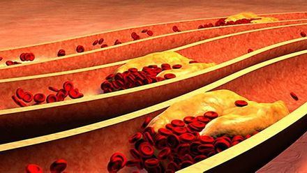 Los altos niveles de colesterol bueno reducen la mortalidad en pacientes de coronavirus