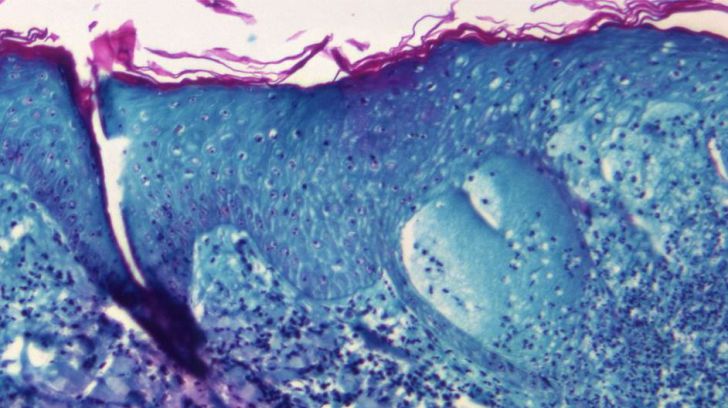 De la gravedad de la viruela del mono al estado del COVID-19 en la actualidad o su origen