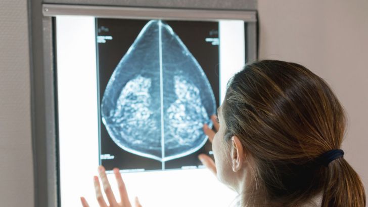 La nueva herramienta que está cambiando la forma en que se trata el cáncer de mama