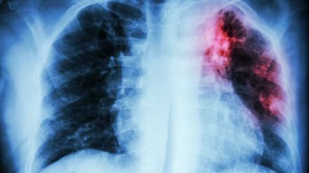 La tuberculosis en datos: 10,6 millones de enfermos y 1,3 millones de muertes en 2022