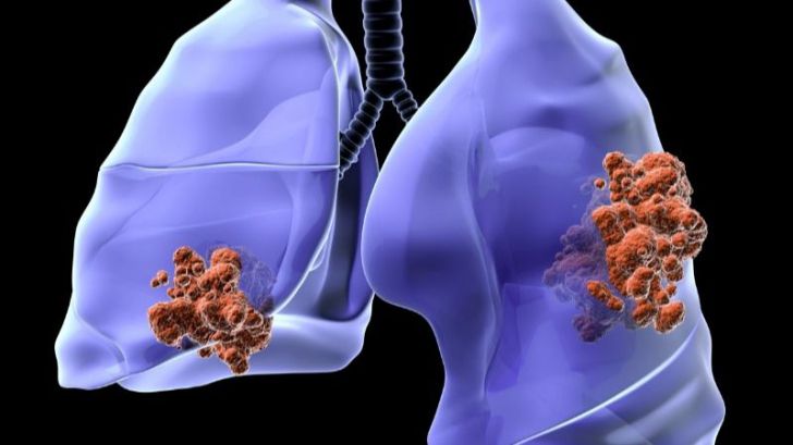 Al descubierto una de las causas de resistencia a la inmunoterapia del cáncer de pulmón