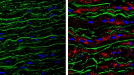 Estudios: Descubren una de las causas de los aneurismas de aorta en el síndrome de Marfan