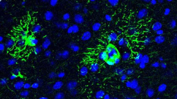 Identifican proteína que anticipa el desarrollo del alzhéimer en el cerebro