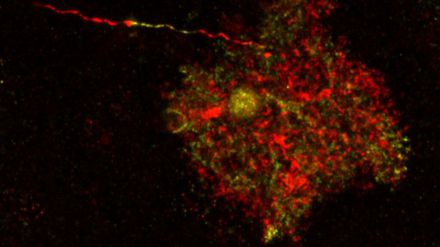 Identifican células cerebrales previamente inofensivas como patológicas en enfermedades neurológicas