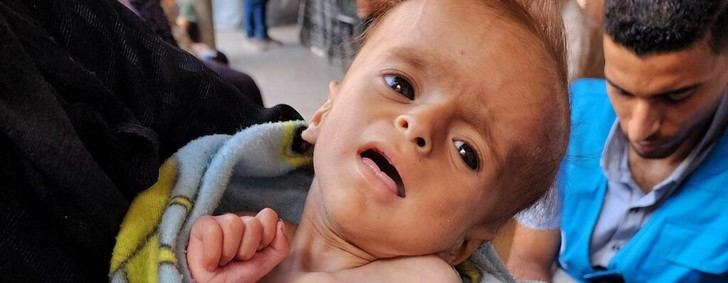 Más de 50 niños mueren de desnutrición en Gaza por el bloqueo humanitario