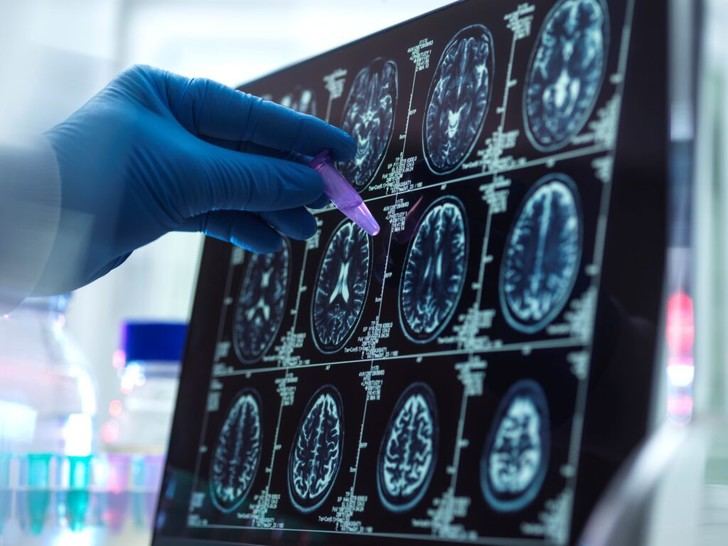 Avance en la detección del alzhéimer: nueva escala de riesgo genético desarrollada por el CSIC