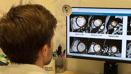 Estudio descarta que la hipertrabeculación ventricular izquierda sea una enfermedad cardíaca peligrosa