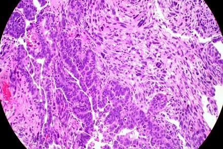 Investigadores hallan un nuevo objetivo terapéutico para el cáncer de endometrio