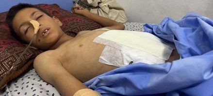 Crisis en Gaza: Hospitales colapsan y surgen enfermedades raras amid la hambruna