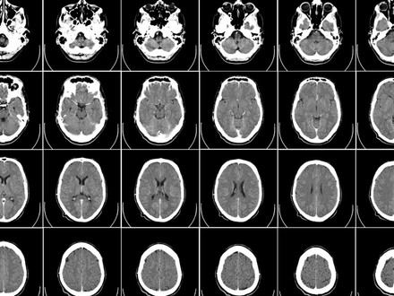 Nuevos hallazgos genéticos mejoran la predicción del trastorno bipolar