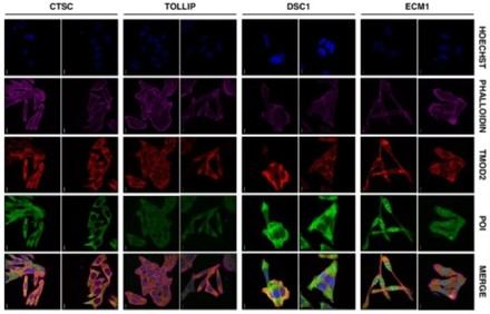 Descubren proteína crucial en la metástasis del cáncer colorrectal