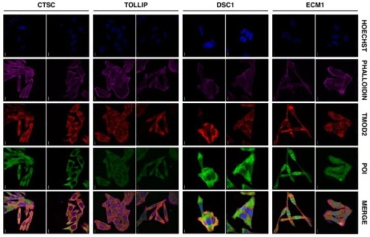 Descubren proteína crucial en la metástasis del cáncer colorrectal