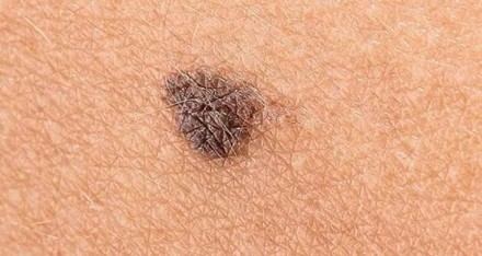 Investigadores de la ULE crean nueva inmunoterapia para combatir el melanoma