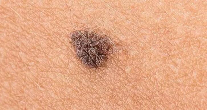 Investigadores de la ULE crean nueva inmunoterapia para combatir el melanoma
