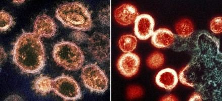 Persistencia del SARS-CoV-2 en personas con VIH revela alteraciones en microARN tras COVID-19