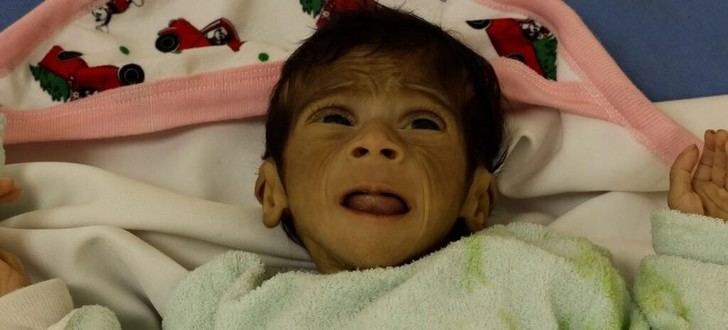 La OMS advierte sobre grave crisis alimentaria en Gaza