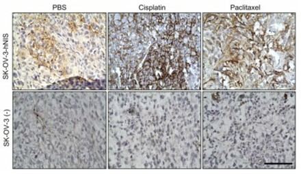 Nuevas esperanzas en el tratamiento del cáncer de ovario con radioyodo