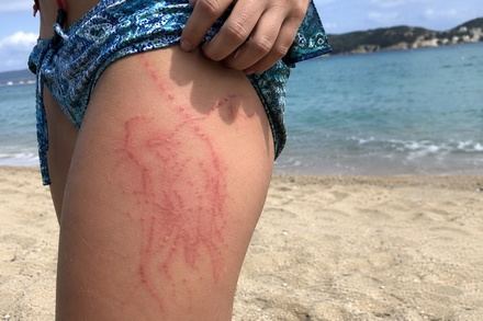 Qué hacer ante la picadura de una medusa: cómo actuar y qué errores evitar