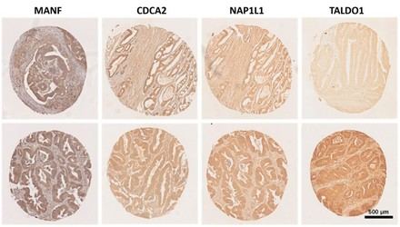Nuevos estudios mejoran la comprensión de las metástasis en cáncer colorrectal