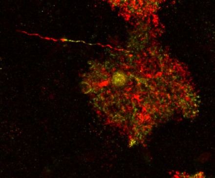 Identifican células cerebrales previamente inofensivas como patológicas en enfermedades neurológicas