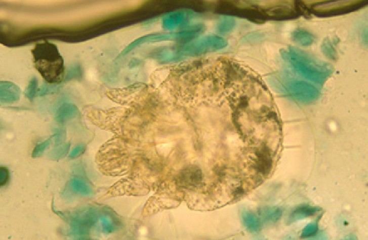 Un estudio del ISCIII alerta sobre el aumento significativo de los casos de sarna en España