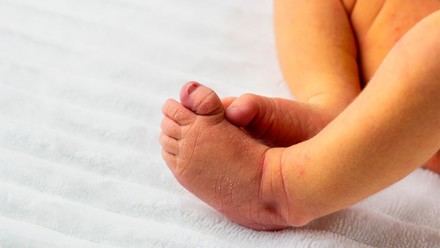 Estudio advierte sobre riesgos de exponer a recién nacidos al sol a través de ventanas para tratar ictericia