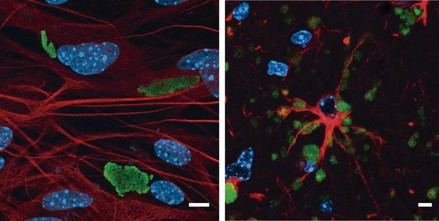 Nuevo modelo celular acelera la investigación de la enfermedad de Lafora, una epilepsia sin cura