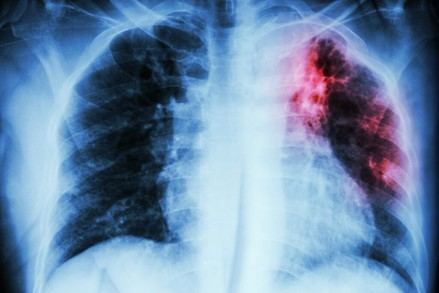 Nuevo método revela variantes genéticas de la bacteria de la tuberculosis