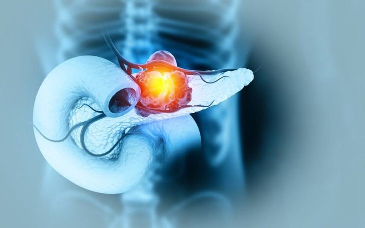 Innovadora combinación de radioterapia y nanopartículas para tratar el cáncer de páncreas