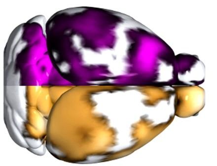 Detectan microtrombos en el cerebro de pacientes con Alzheimer mediante una nueva técnica de imagen no invasiva