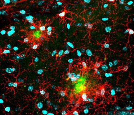 Investigación revela un mecanismo inmunitario que aumenta la vulnerabilidad de las mujeres al alzhéimer