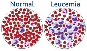 La leucemia recurrente prodría curarse.