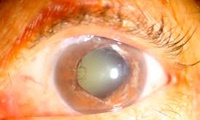 Los anti-inflamatorios después de la cirugía de glaucoma son innecesarios
