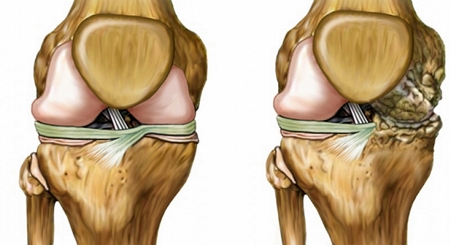 La combinación de dos fármacos permite reducir el dolor en pacientes con artrosis de rodilla