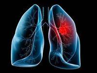El cribado podría reducir la mortalidad por cáncer de pulmón en un 20%