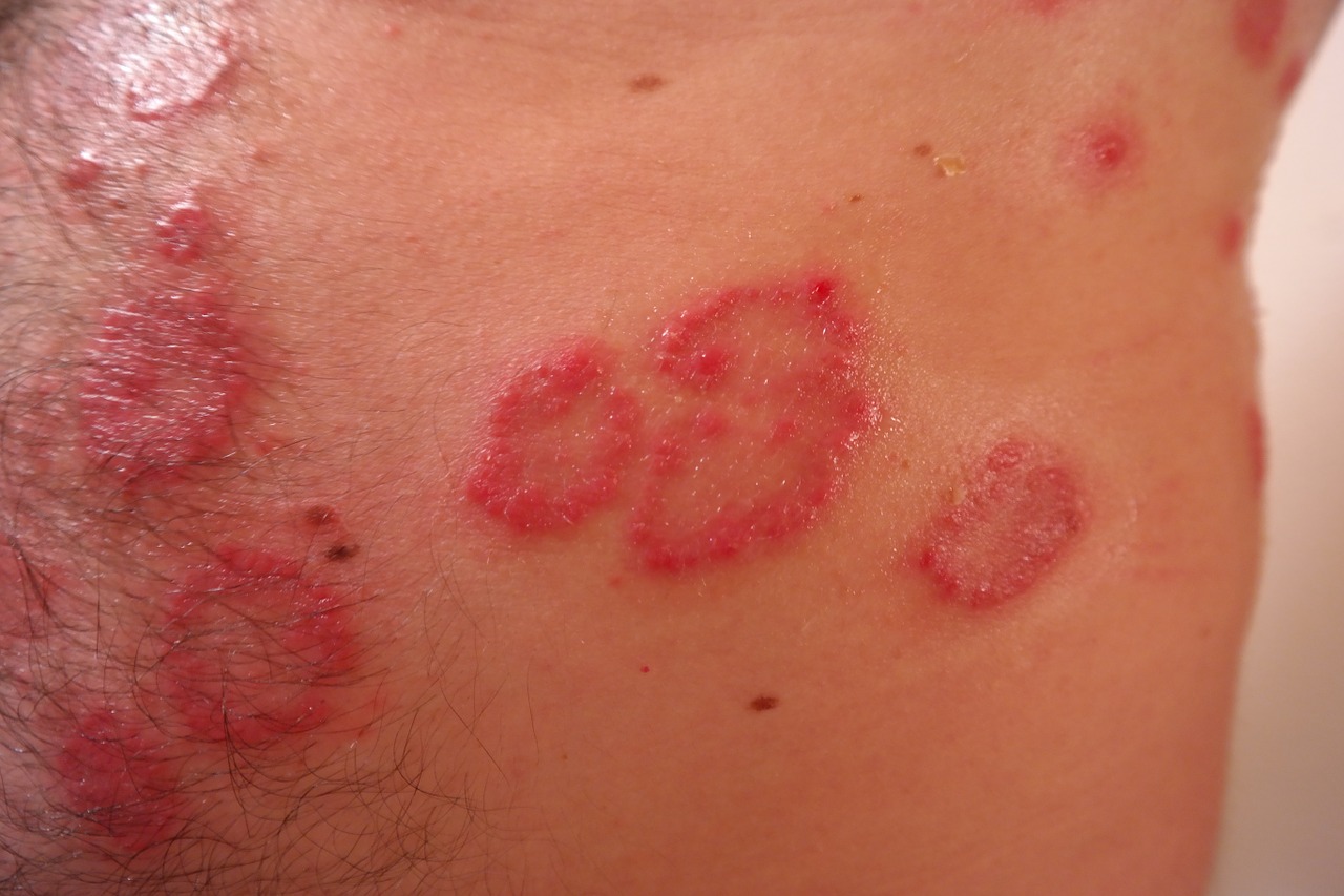 Más de la mitad de los pacientes con psoriasis padecen disfunción sexual