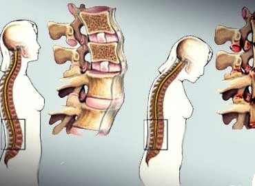 La espondilitis anquilosante, una enfermedad silenciosa aunque dolorosa