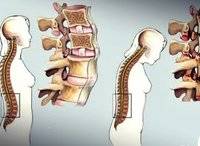 La espondilitis anquilosante, una enfermedad silenciosa aunque dolorosa